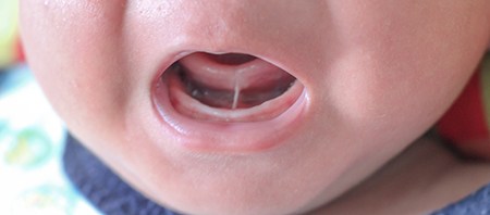 Close-up of frenulum under baby’s tongue