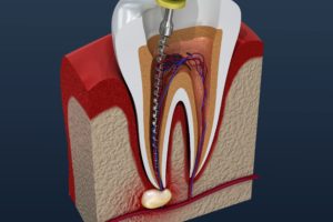 model of root canal