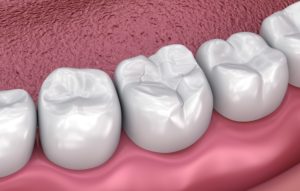 Model of tooth-colored filling from holistic dentist in Southlake. 