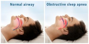 Model of obstructive sleep apnea in Southlake.