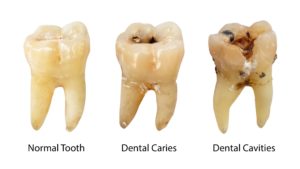 Holistic dentist in Southlake shows stages of tooth decay.