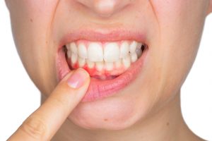 Oral infection that needs treatment from holistic dentist in Southlake. 