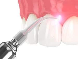 Illustration of laser dentistry in Southlake being used on gums