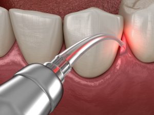 Illustration of laser being used for gum disease treatment in Southlake