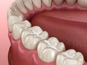 Illustration of biocompatible fillings in Southlake on bottom teeth